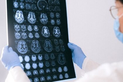 Alzheimer : un acide aminé courant freinerait la maladie