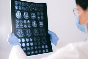 Alzheimer : un acide aminé courant freinerait la maladie