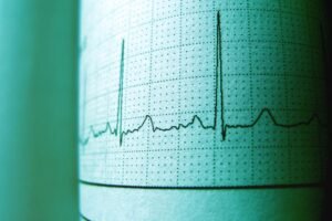 Une IA détecte les maladies cardiaques sur un ECG en 2 secondes
